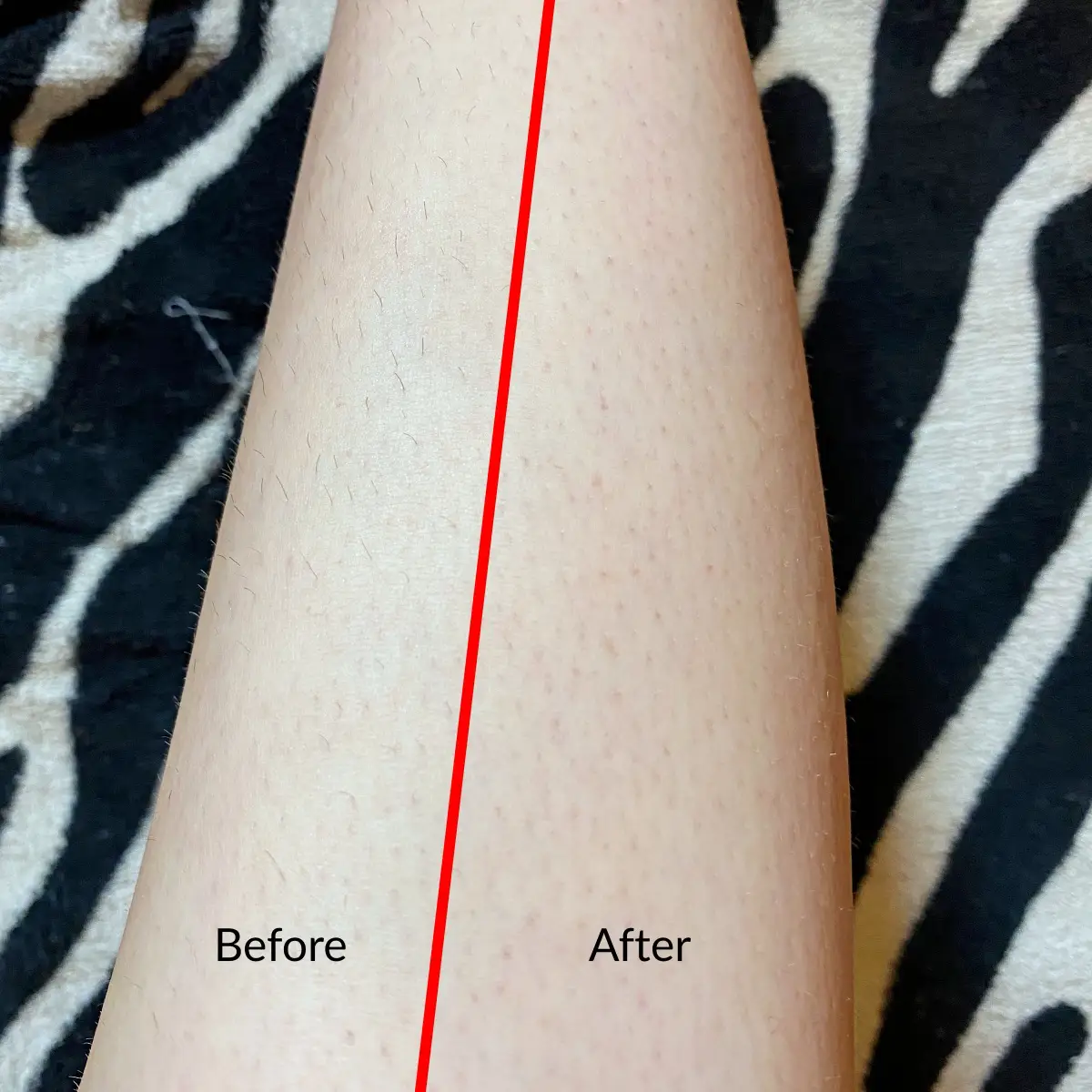 crystal hair removal before and after