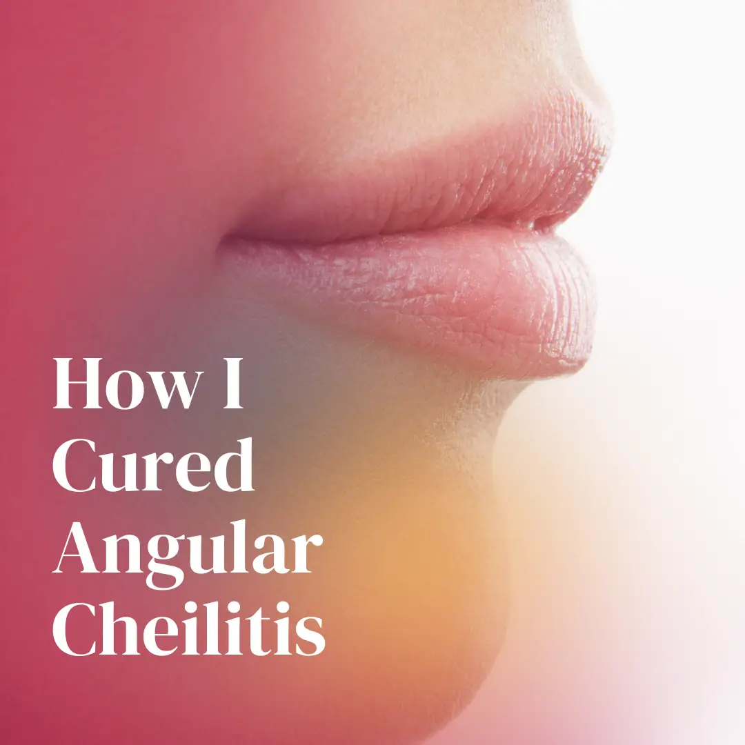 angular cheilitis treatment